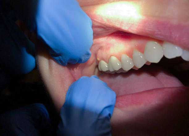 Best Knocked-Out Tooth (Avulsed Tooth) Treatment in Mathews, LA